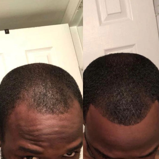 Minoxi 5% Hair Growth Foam
