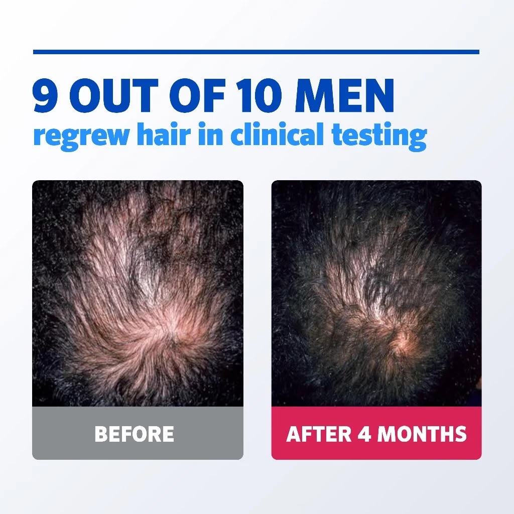 Minoxi 5% Hair Growth Foam