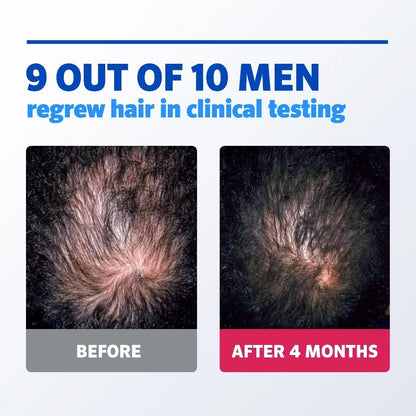 Minoxi 5% Hair Growth Foam